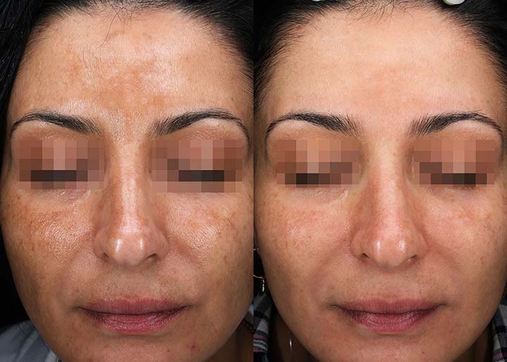 Melasma_ba_001-1