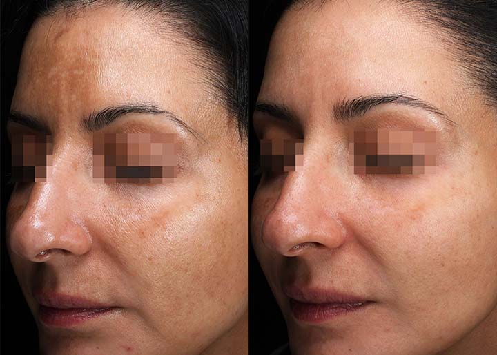 Melasma_ba_002-1