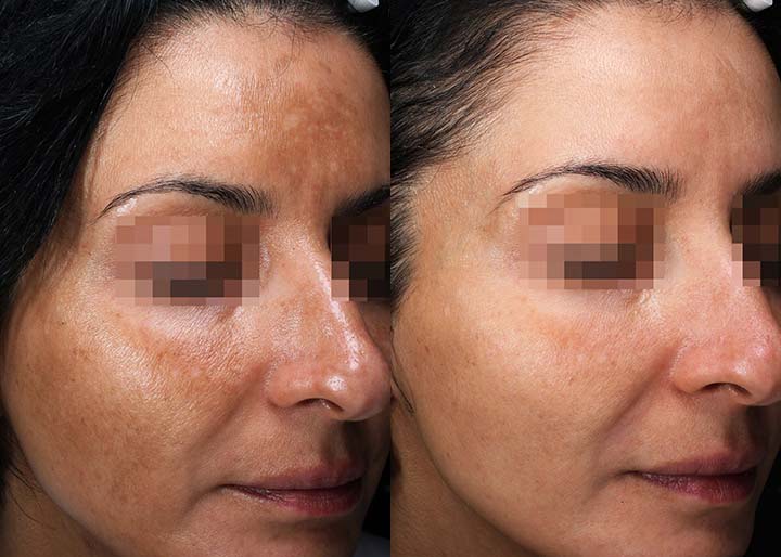 Melasma_ba_003-1