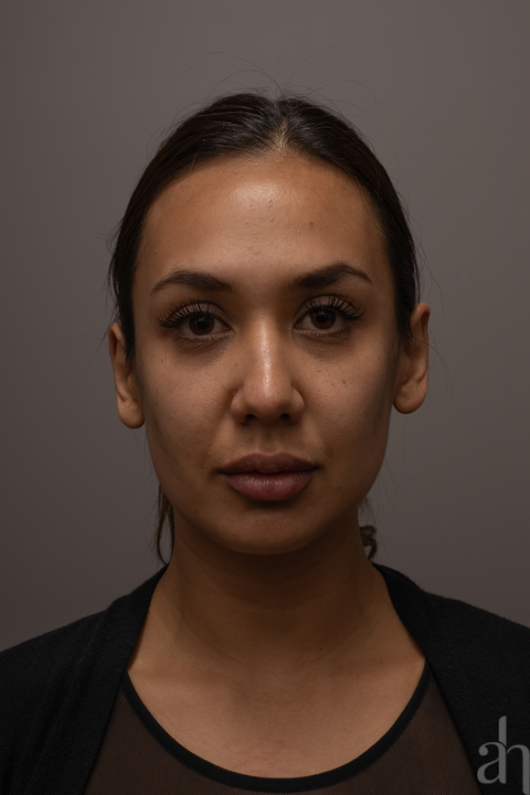 clinical photography - 2d clinical imaging - photo 03 - front side view