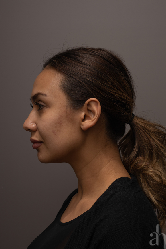 clinical photography - 2d clinical imaging - photo 05 - left side view