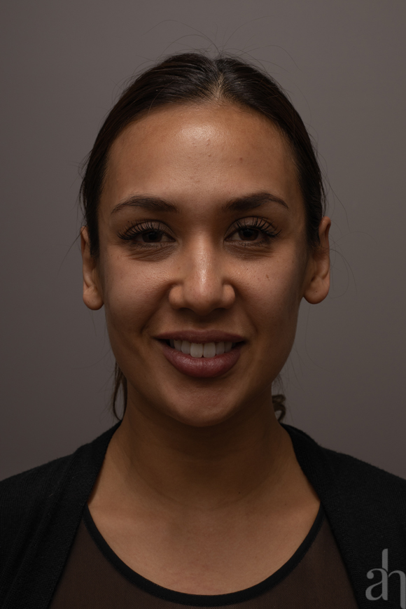 clinical photography - 2d clinical imaging - photo 06 - front 001 - smiling