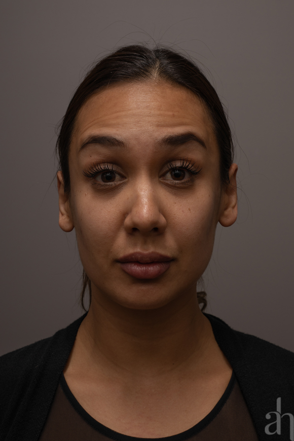 clinical photography - 2d clinical imaging - photo 08 - front 003 - surprised face look